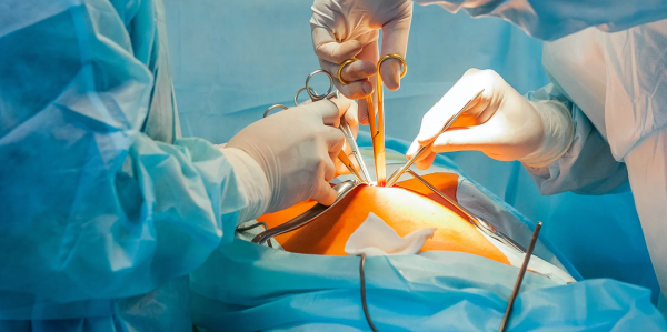 Peritoneal Surface Malignancies